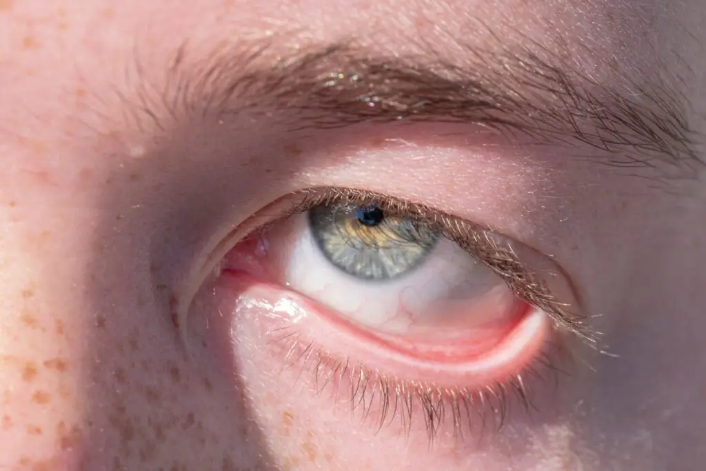 Are pink eyes real?