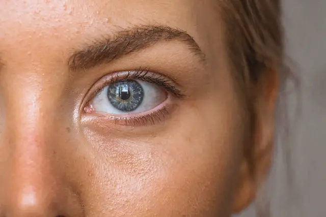 Does latisse cause fat loss around the eyes?
